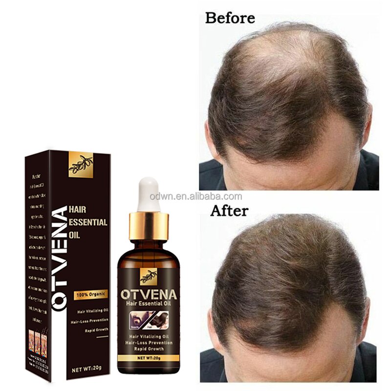 Hair Growth Oil Manufacturer - Organic Fast Hair Loss Treatment