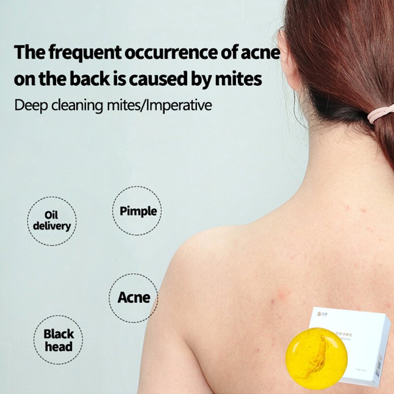 Anti-mite Soap Supplier - OEM Control Oil Eliminate Acne Moist
