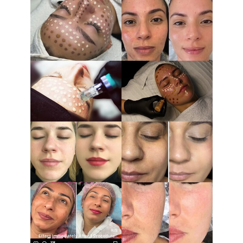 BB Serum Kit Supplier - Customized Lan Frost Treatment Start Anti-Acne