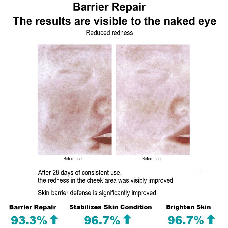 Acne Repair Gel Serum Manufacturer - OEM Wholesale Private Label Sensitive