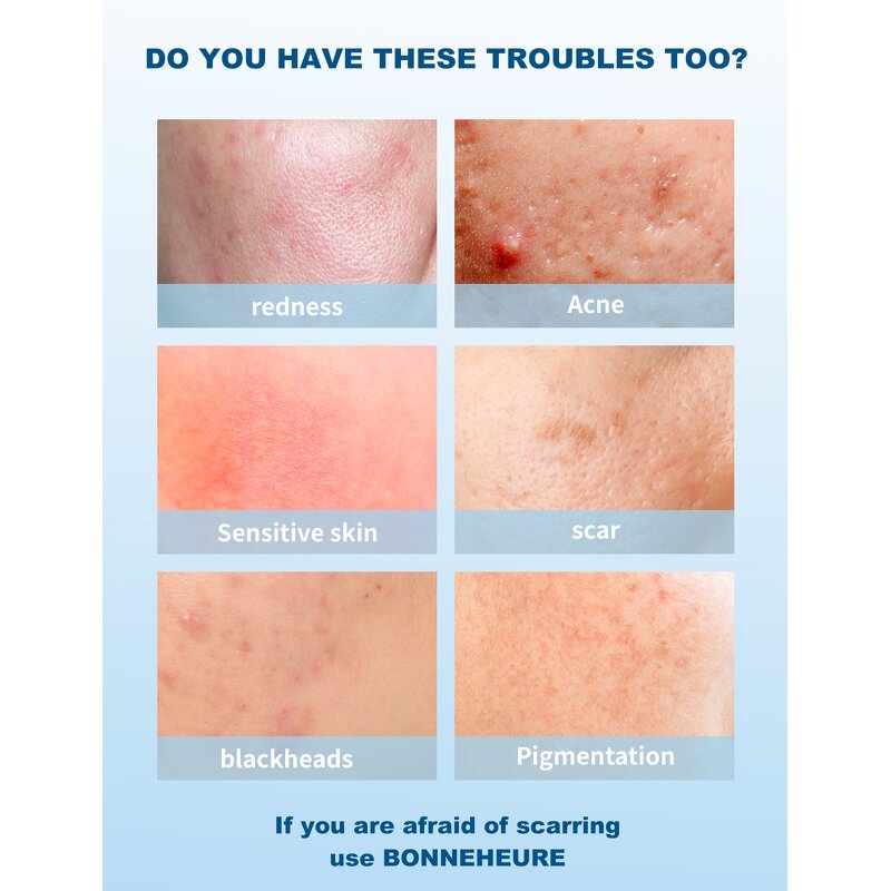 Hydrating Anti Acne Serum Supplier - OEM Natural Plant Extracts Soothing