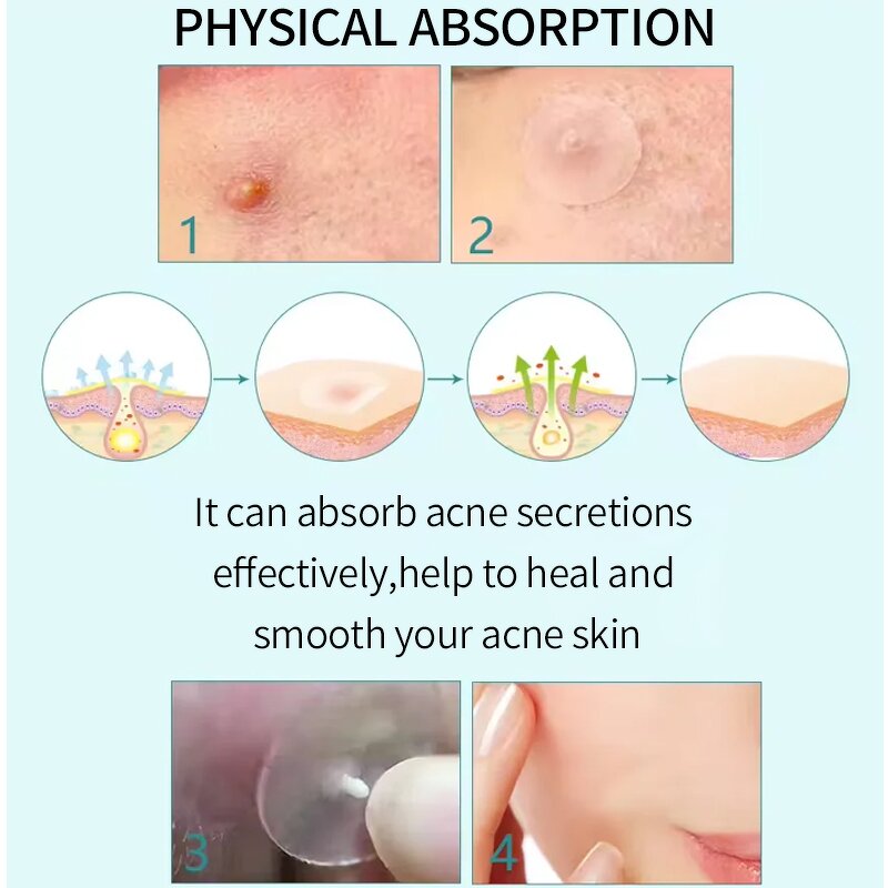 Hydrocolloid Acne Patch Factory - OEM Waterproof Custom Star Pimple