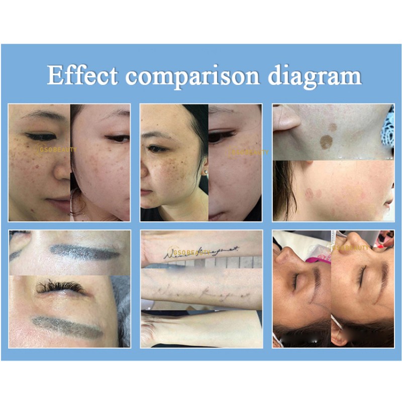 Laser Machine Manufacturer - Picosecond Q Switch Tattoo Removal