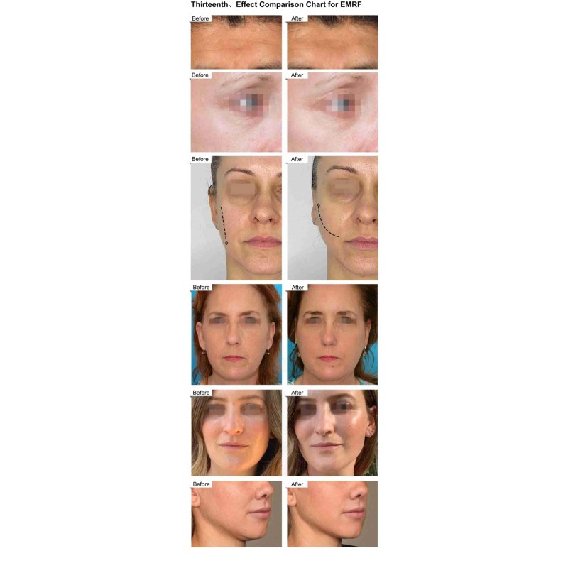 Body Slimming Machine Supplier - RF EMS Muscle Stimulator 635nm