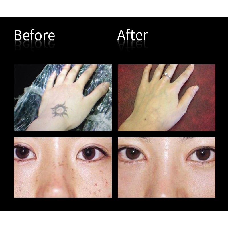 Nd Yag Laser Manufacturer - Professional Tattoo Pigment Removal