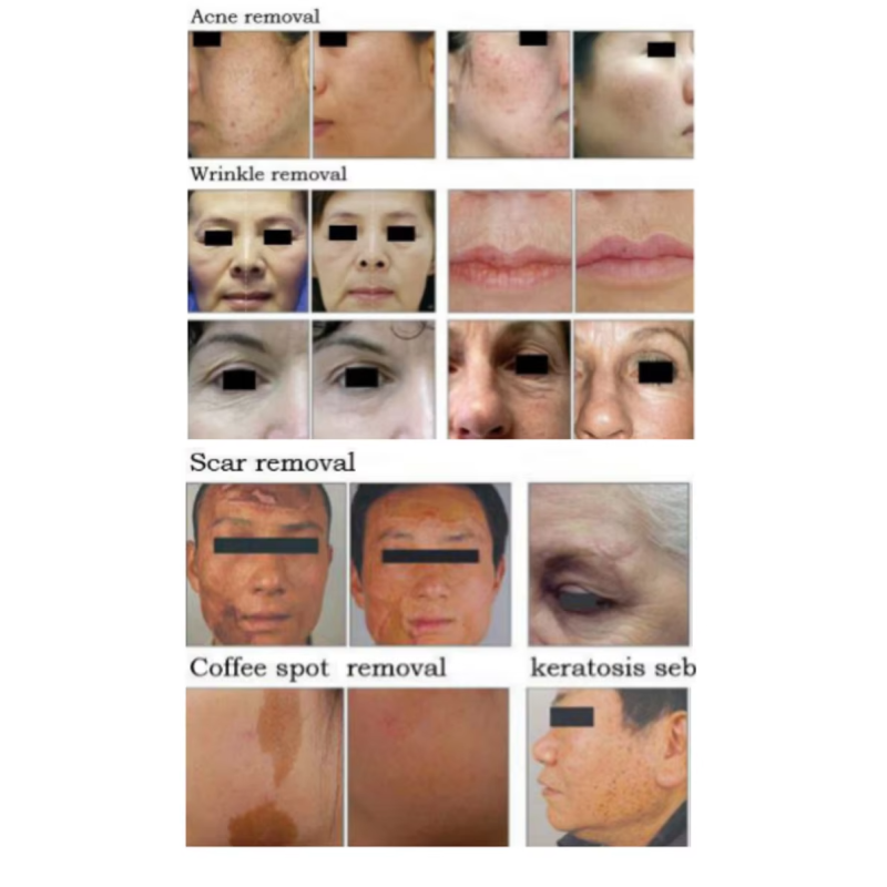 CO2 Laser Machine Factory - OEM Fractional Acne Scar Removal