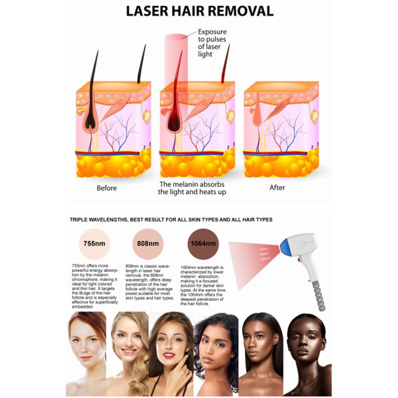 Laser Hair Removal Machine Supplier - High Power Triple Wavelength