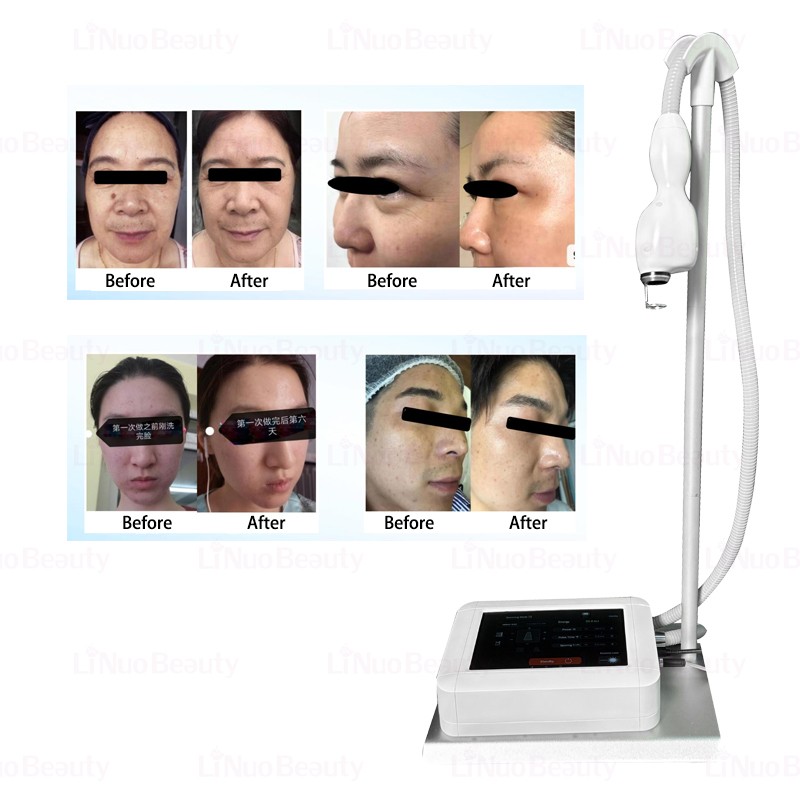 Fractional Laser Machine Manufacturer - 1940nm Spot Removal Face Lifting