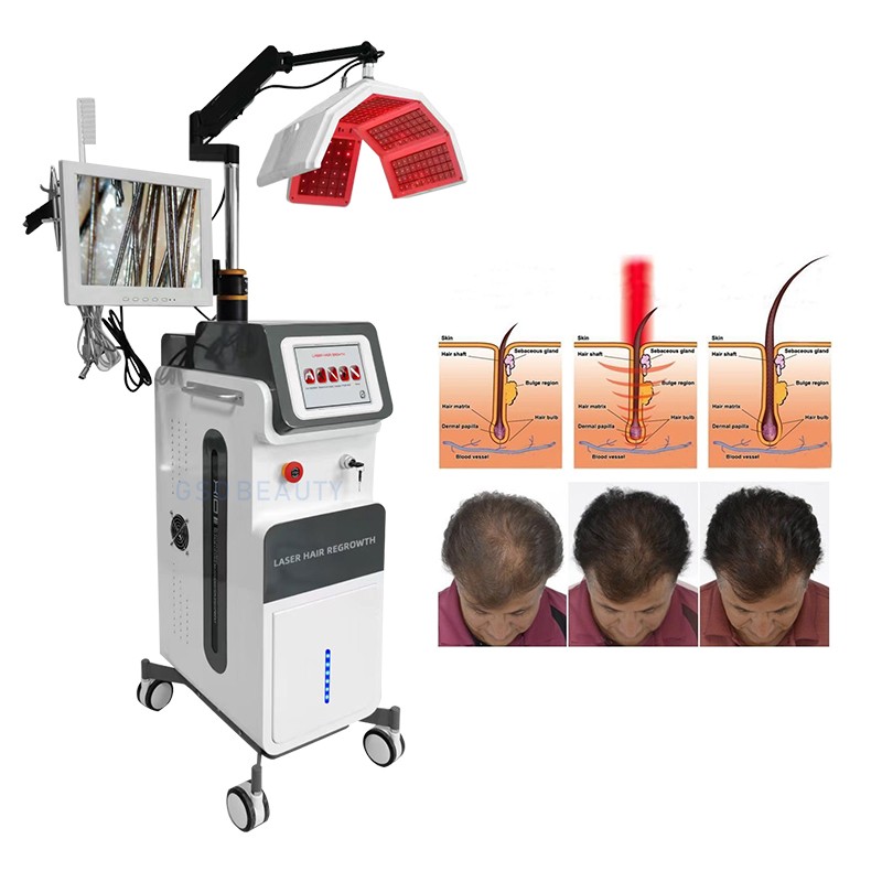 Hair Loss Treatment Machine Supplier - Newest 660nm Diode Laser