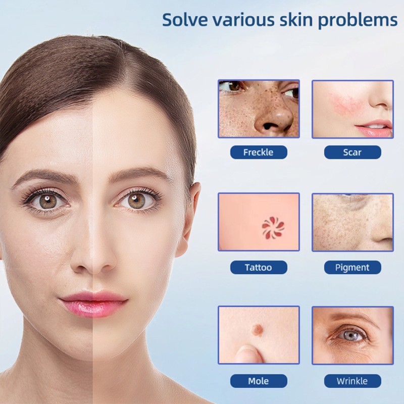 Plasma Pen Manufacturer - Cheap Price Fibroblast Lifting