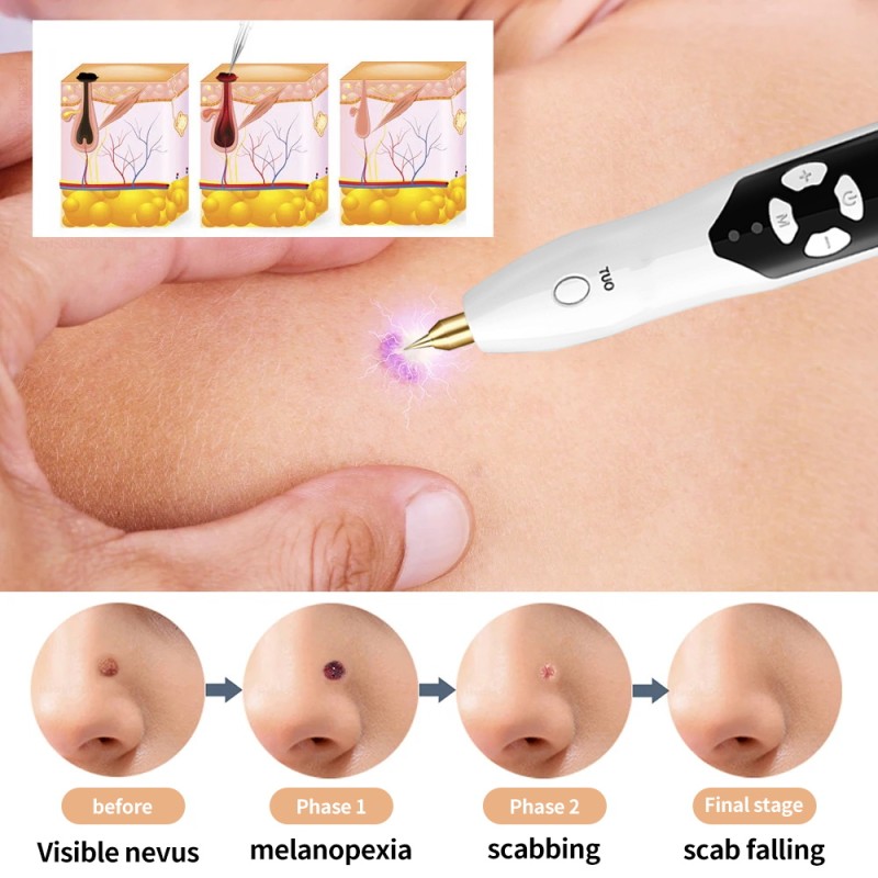 Plasma Pen Manufacturer - USB Rechargeable Home Use Handheld