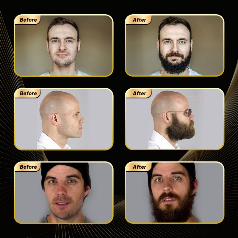 Gold Derma Roller Manufacturer - Luxury DRS 250 Wrinkles Scars Acne