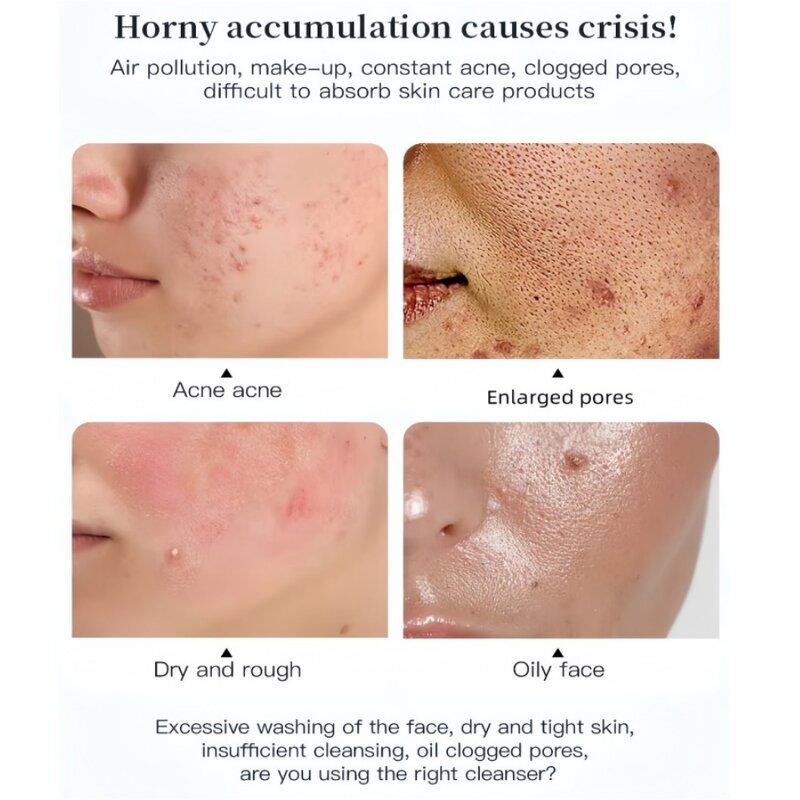 Anti Acne Cleanser - Salicylic Acid Foaming Face Wash Deep Cleansing Mousse