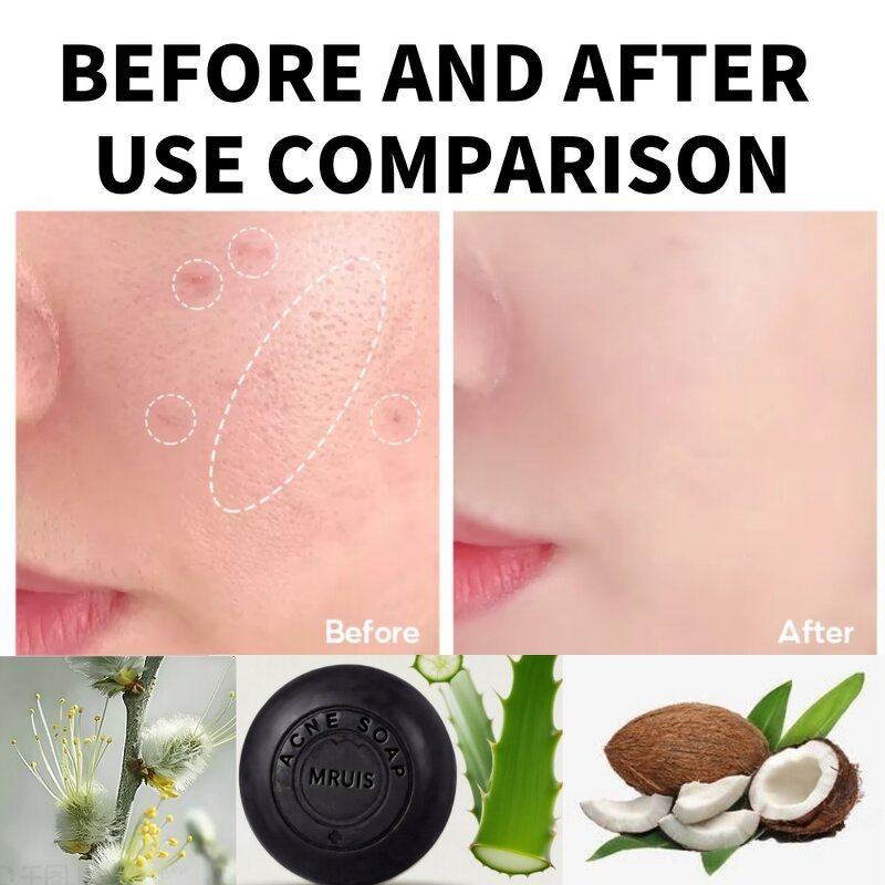 Salicylic Acid Soap Bar - 100g Deep Cleansing Anti-Acne Whitening