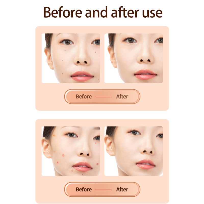 Laser Plasma Pen Manufacturer - Skin Tag Freckle Papilloma Remover