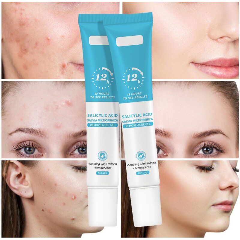 Anti-Acne Face Gel Manufacturer - Private Label Quick Salicylic Acid Herbal for Pimples and Scars