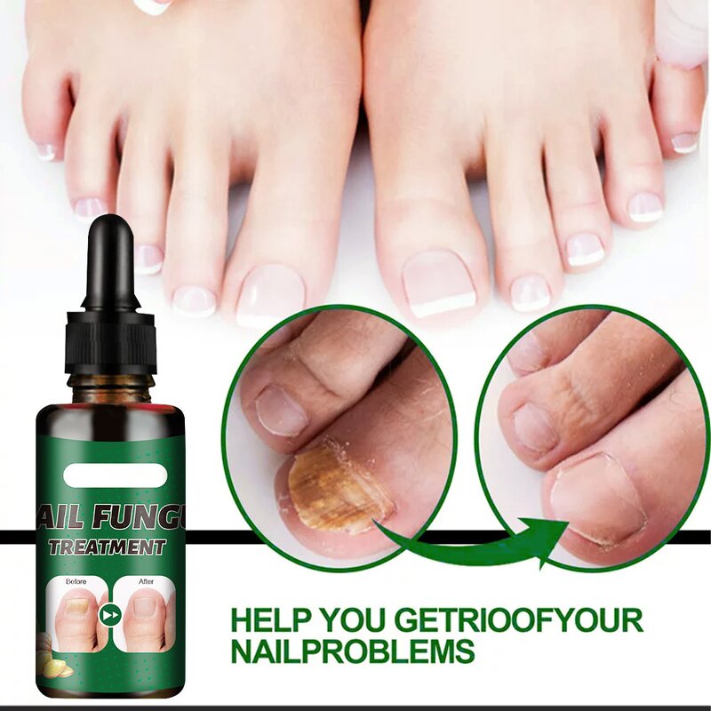 Nail Fungus Treatment Manufacturer - Deep Nourishing Wholesale Herbal Whitenail Ginger Soothing Discomfort Ingredients