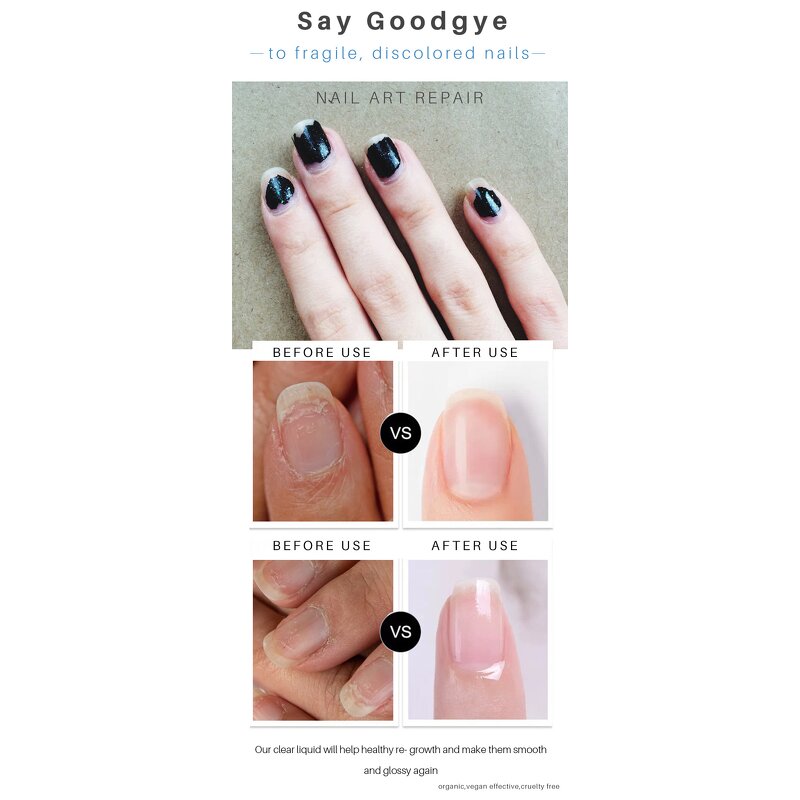 Nail Repair Pen Manufacturer - 4ml Anti Fungal Treatment for Onychomycosis Paronychia Finger Toenail Fungus