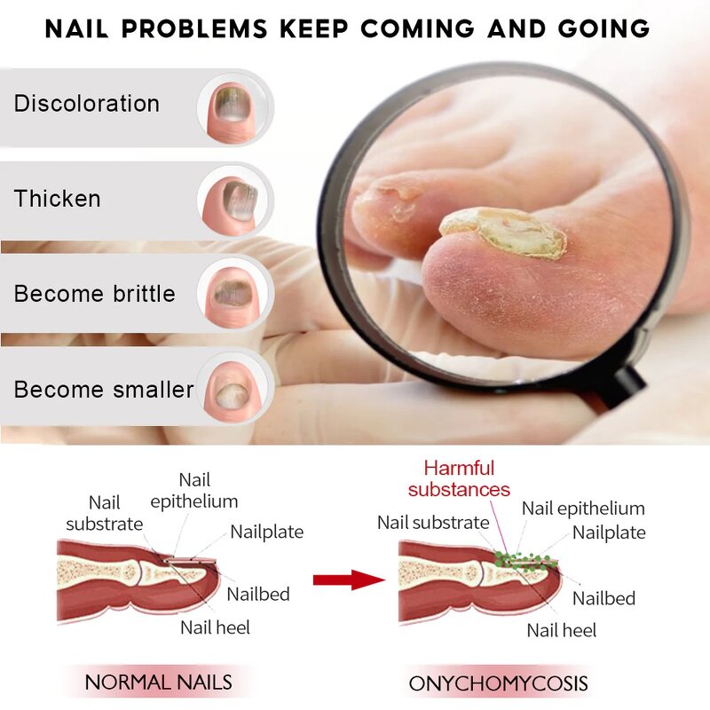 Nail Fungus Treatment Manufacturer - Deep Nourishing Wholesale Herbal Whitenail Ginger Soothing Discomfort Ingredients