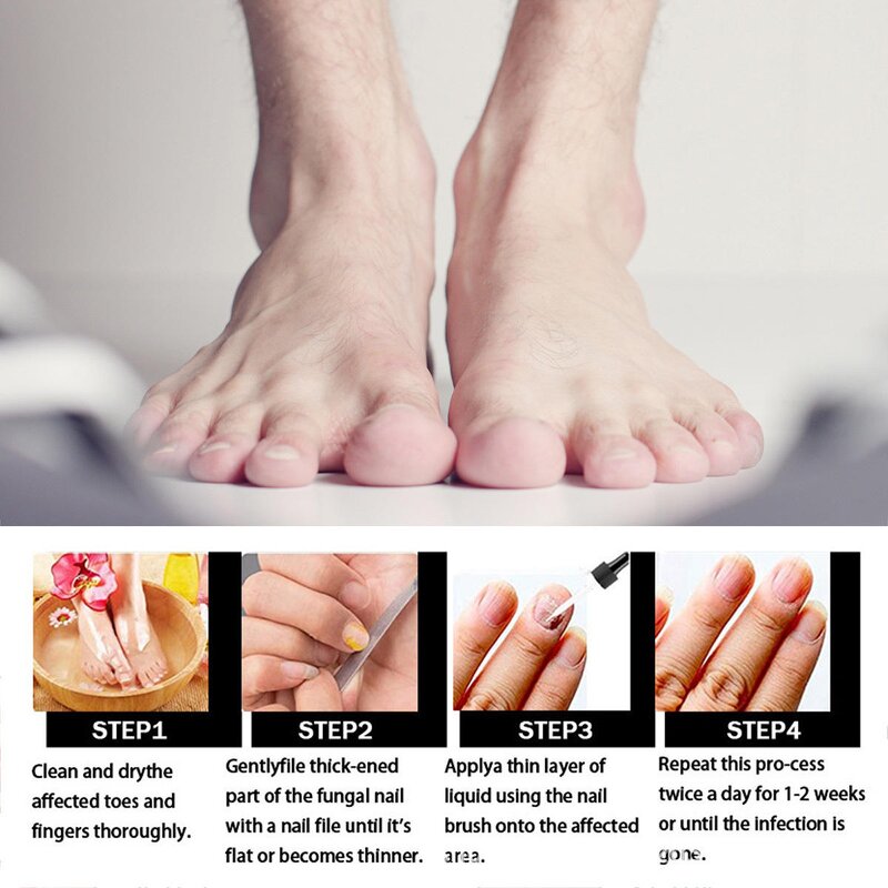 Nail Fungus Treatment Liquid Manufacturer - Wholesale Herbal with Ginger Extract 7 Days Cuticle Repair & Strengthening