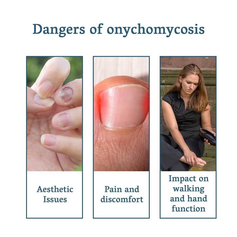 Nail Repair Serum Gel Manufacturer - Maximum Strength Anti-Infection for Onychomycosis Paronychia Fungal Treatment