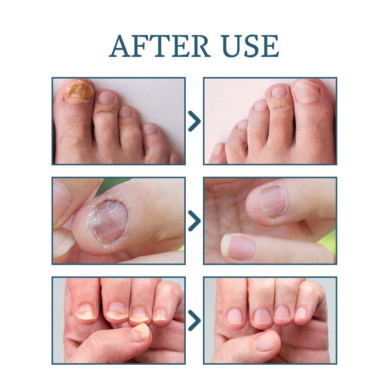 Nail Repair Serum Gel Manufacturer - Maximum Strength Anti-Infection for Onychomycosis Paronychia Fungal Treatment