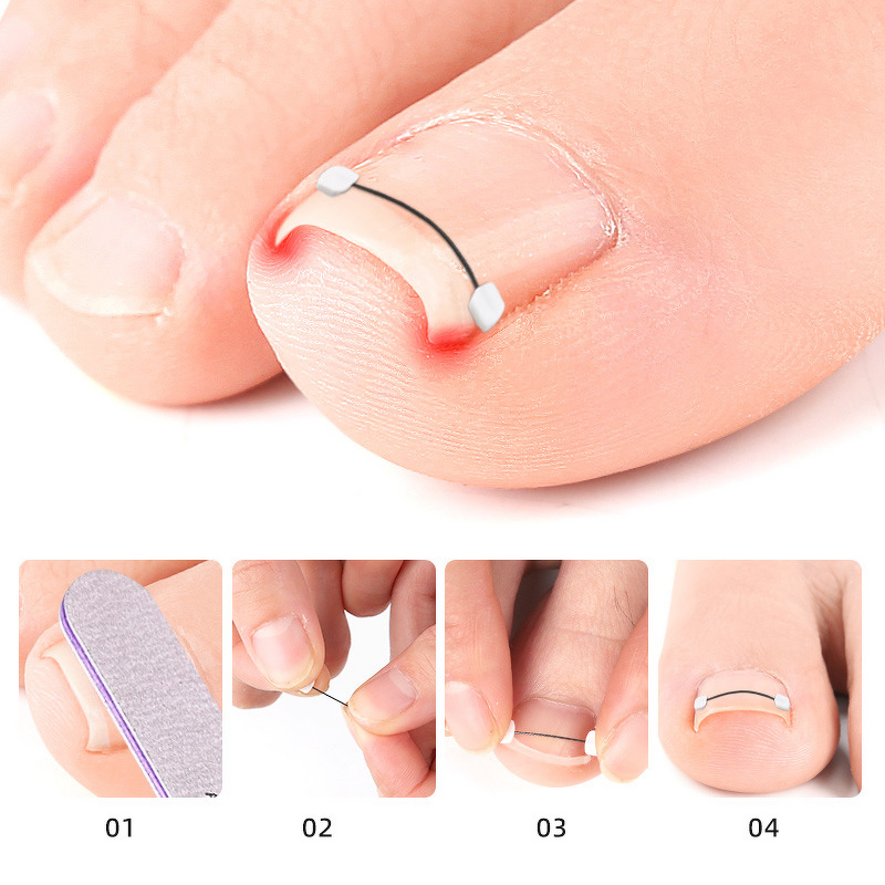 Ingrown Toenail Corrector Manufacturer - at Home Treatment Curved Toenail Straightener Ingrown Toe Nail Relief
