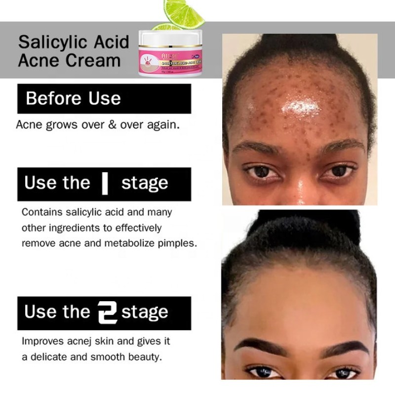 Acne Face Cream Manufacturer - OEM Salicylic Acid Scar Removal Moisturizer