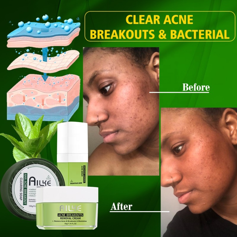 Acne Set Manufacturer - OEM Professional Anti Acne Products