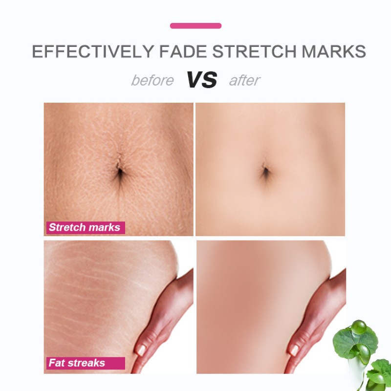 Stretch Marks Cream Factory - OEM Pregnancy Scar Removal