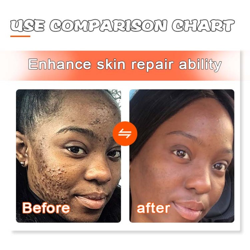 Bath Soap Factory - OEM Shea Butter Turmeric Acne Whitening