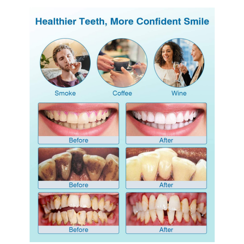 Ultrasonic Tooth Cleaner - Electric Tartar Stains Removal Oral Cleaning Machine