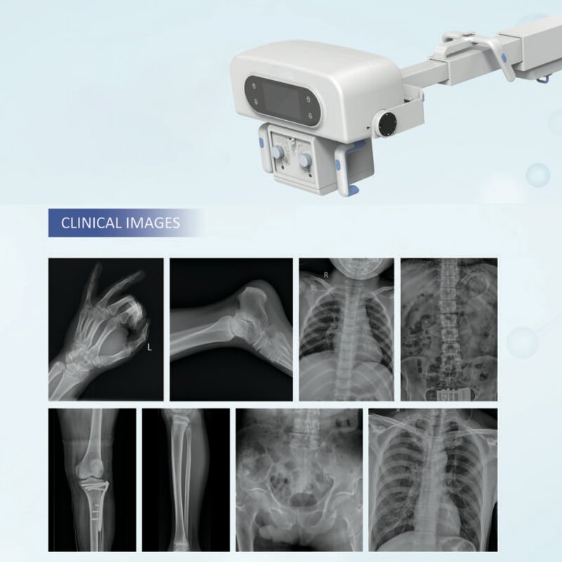 Mobile DR X-ray Machine - Portable Digital Medical Radiographic/fluoroscopic System