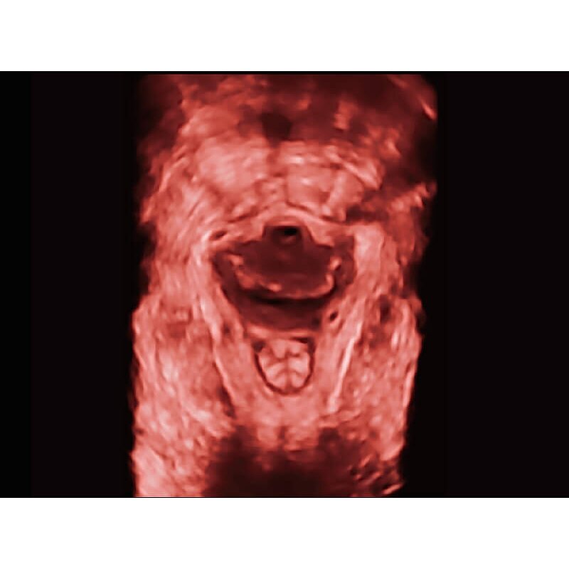 Portable Ultrasound Machine - Cheaper 3D 4D 15" High Resolution Laptop Echo Machine