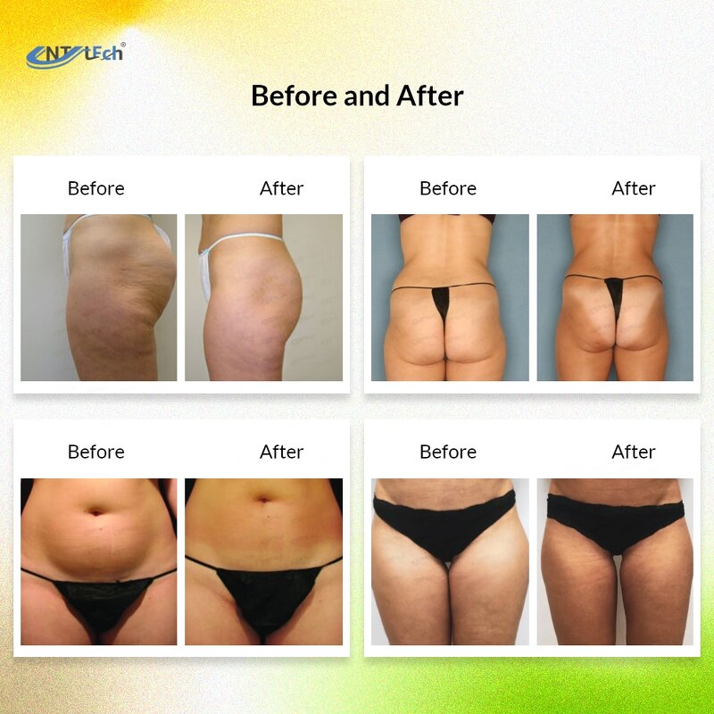 V Shape 3 Lipo Machine - 80K Rf Vacuum Cavitation Cellulite Reduction Device