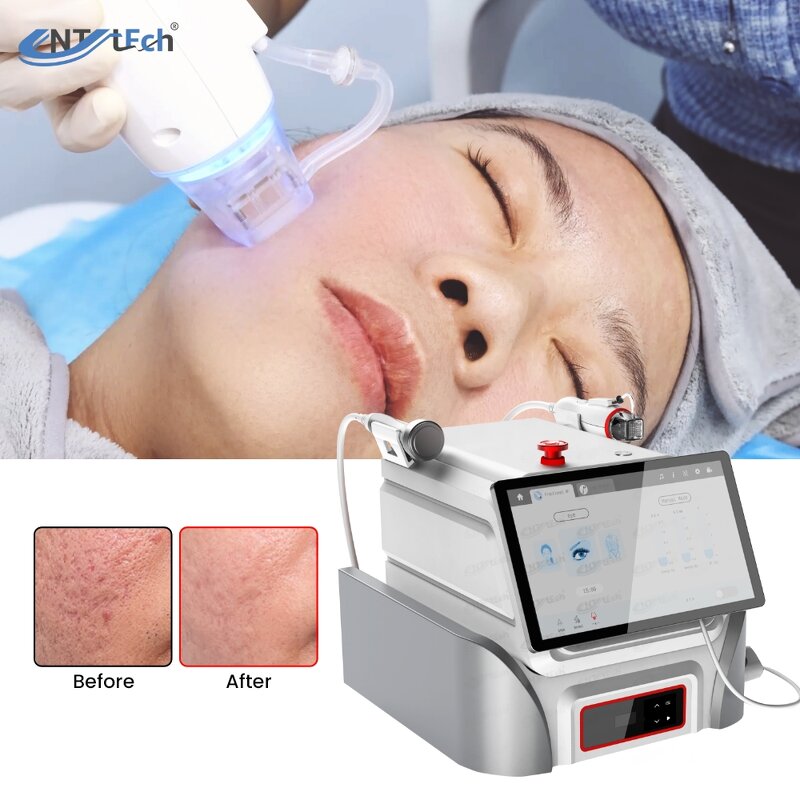 RF Microneedling Machine - UNT Newest Micro Needle Vacuum Skin Tightening Device