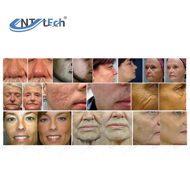 Co2 Fractional Laser - 40W Scar Removal Vaginal Tightening Beauty Machine