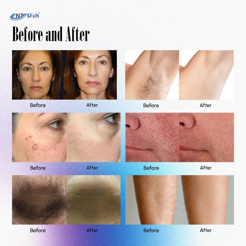 Alexandrite Laser Machine - 755nm Nd Yag Hair Removal Skin Rejuvenation Device