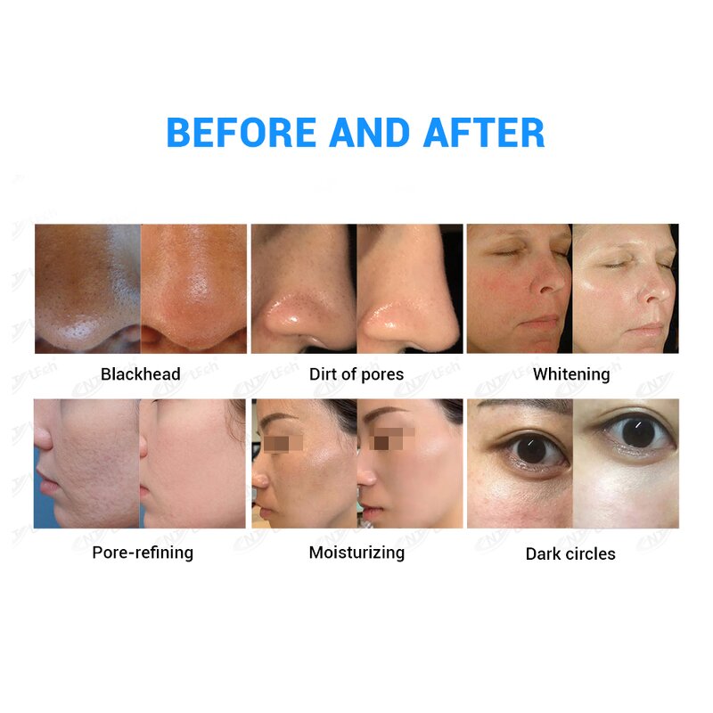 7 in 1 Facial Machine - Microdermabrasion Hydra Diamond Oxygen Jet New Device