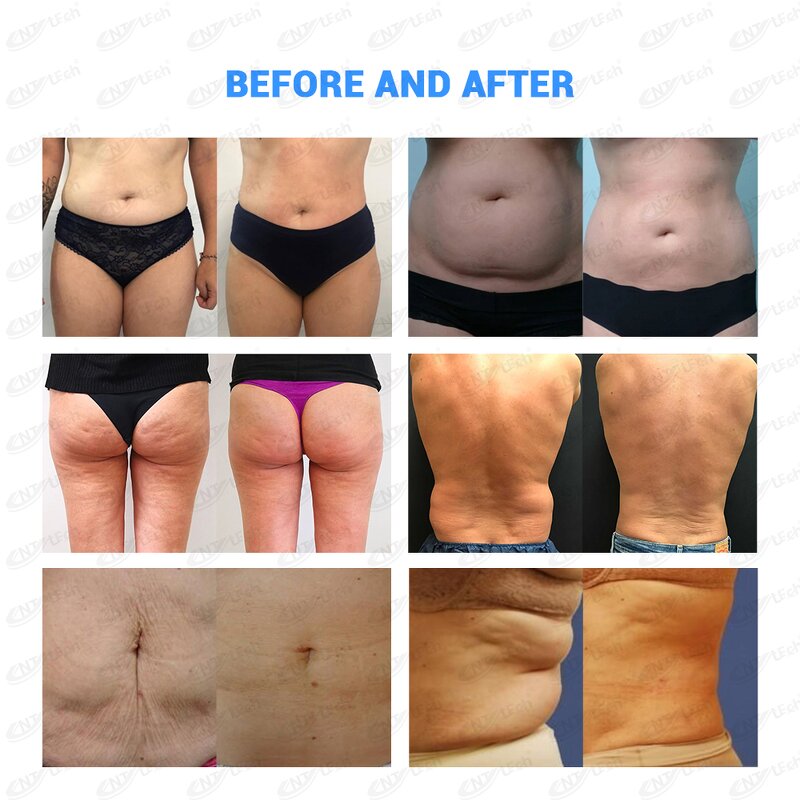 Vela RF Roller Machine - Newest Technology Body Contouring Shape Slimming Device