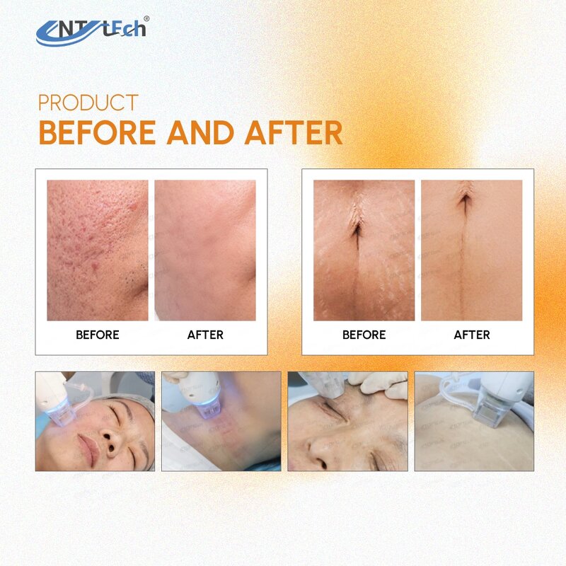 Gold Microneedling Rf Needles - Wrinkle Removal Face Lifting Microneedle Machine