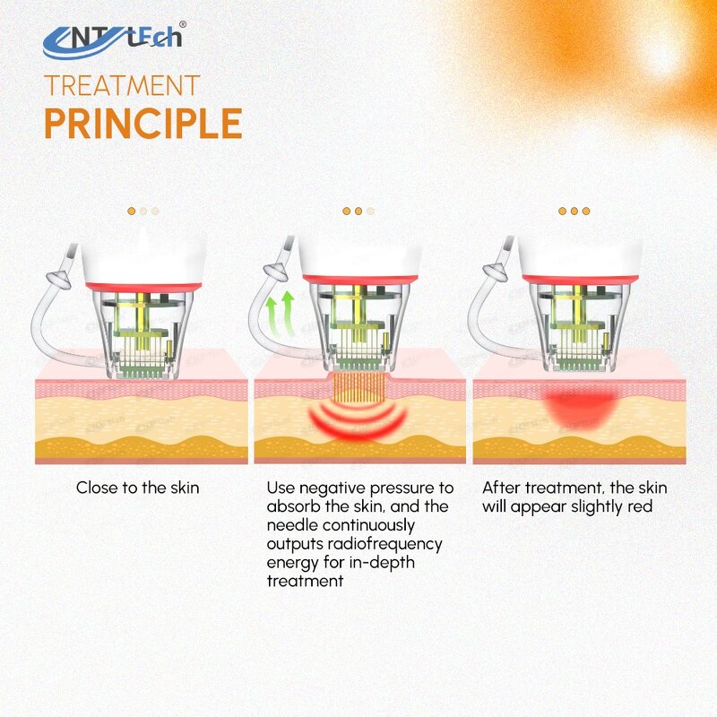 Golden Microneedle Rf Needles - 36 Pins Wrinkle Remover Microneedling Machine