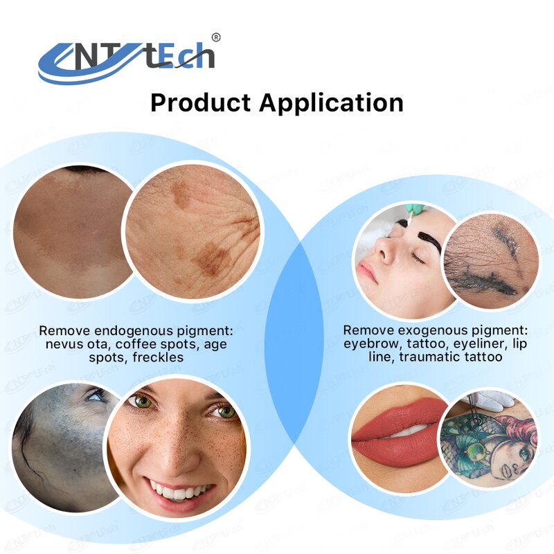 Q Switch Nd Yag Laser - Portable Freckle Tag Wart Tattoo Removal Machine