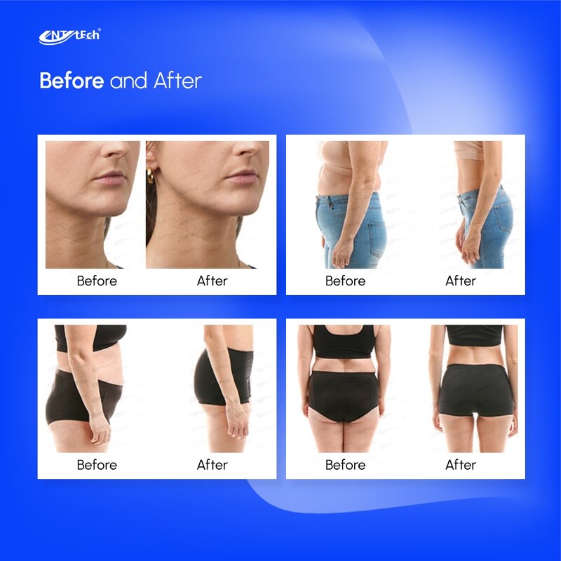 Cryo Therapy Machine - UNT 5 Handles Vacuum Cavitation 360 Body Sculpting