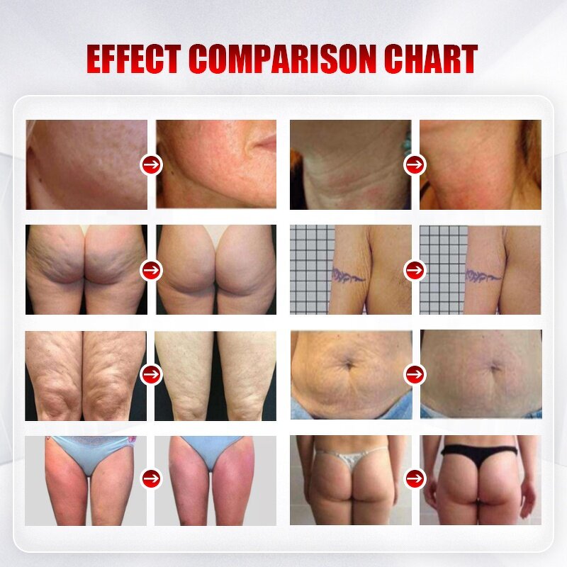 Body Slimming Machine Manufacturer - Vela Slim RF VACUUM for Fat Remove & Butt Lift