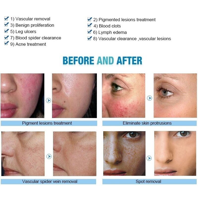 Spider Vein Removal Machine Manufacturer - In Stock