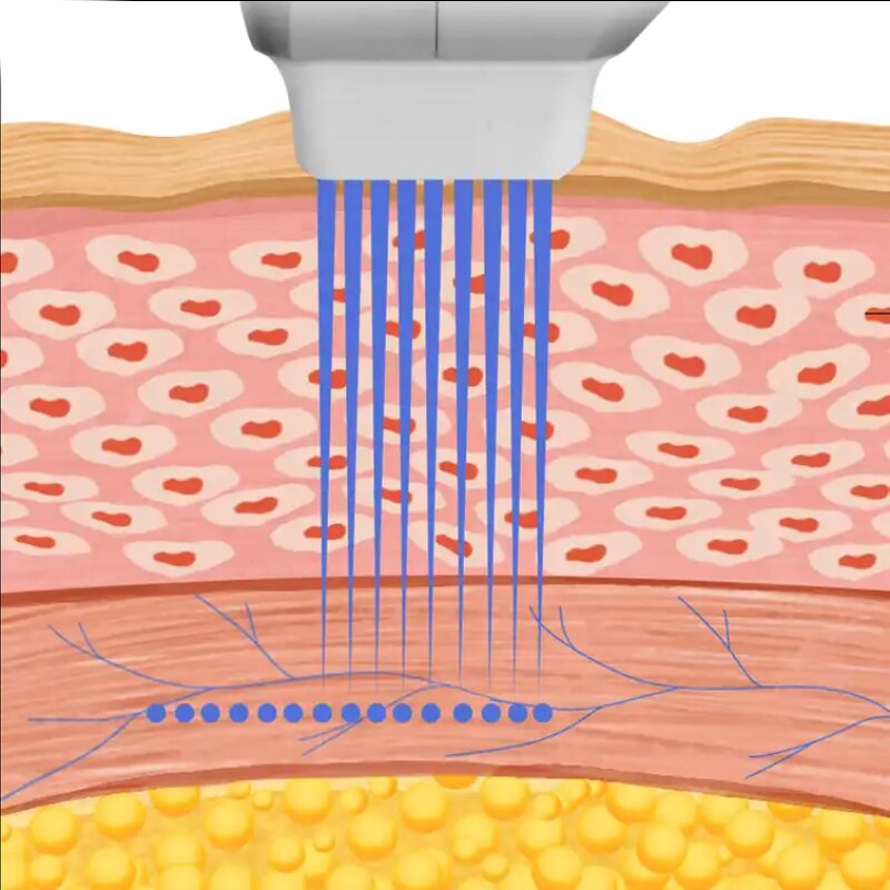 Skin Care Machine Manufacturer - 7D for Skin Tightening & Face Lifting