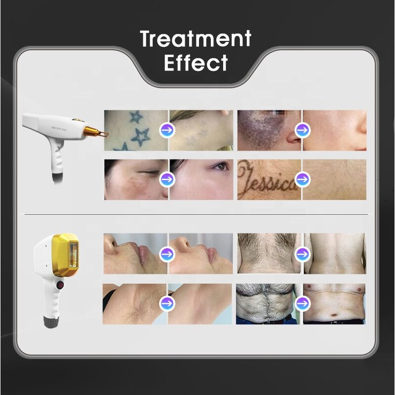 Laser Hair Removal Machine Manufacturer - 2000W 3000W 4 Wave Permanent 808nm