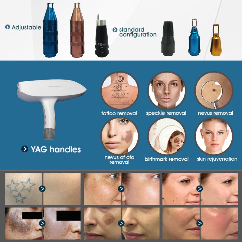 Laser Machine Manufacturer - 4 in 1 RF ELIGHT ND YAG OPT IPL for Scar & Tattoo Removal