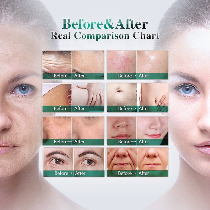 Microneedling Machine Manufacturer - Hottest Portable Micro Needling